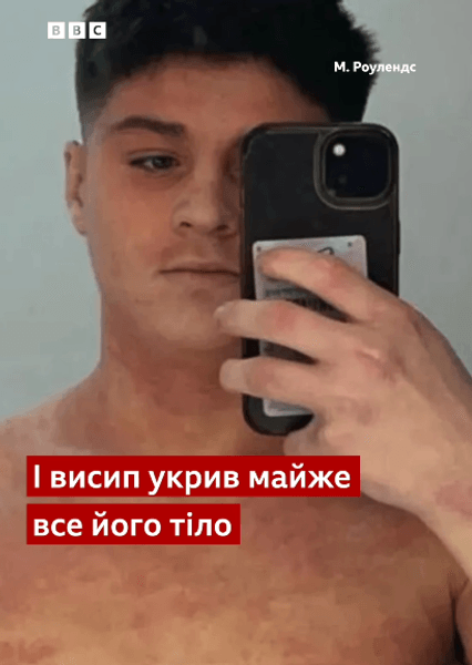 Хлопець з екземою хлопець перестав користуватись кремом і не може рухатись